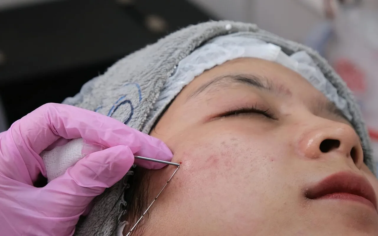 Microneedling